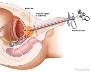 cancerul-de-prostata